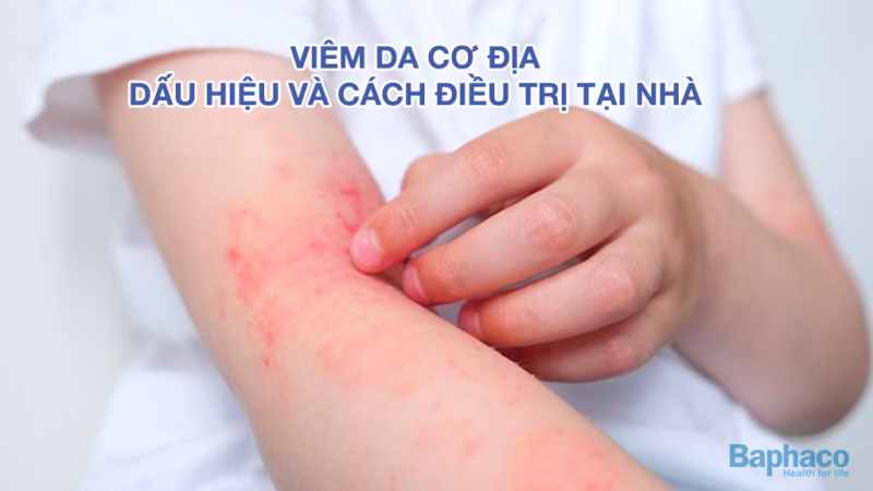 Viêm da cơ địa là gì? Dấu hiệu và cách điều trị hiệu quả tại nhà